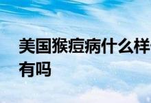 美国猴痘病什么样子有图片吗 猴痘疫苗中国有吗