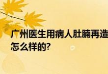 广州医生用病人肚腩再造乳房 网友直呼好消息 具体情况是怎么样的?