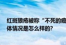 红斑狼疮被称“不死的癌症” 患红斑狼疮什么症状图片 具体情况是怎么样的?