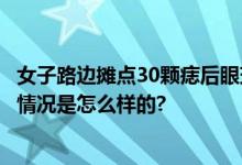 女子路边摊点30颗痣后眼球被烧伤3层 网友：得不偿失 具体情况是怎么样的?